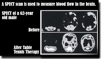 images of brain scans before and after a game of table tennis